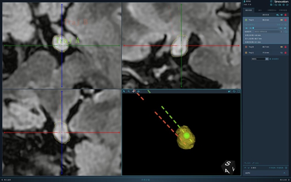 插入腫瘤的2根電極示意圖。重醫(yī)附屬兒童醫(yī)院供圖