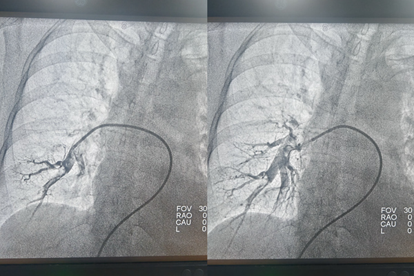 手術(shù)前后肺動脈造影對比。重慶兩江新區(qū)人民醫(yī)院供圖