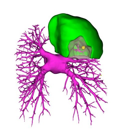 通過三維重建技術(shù)鎖定病灶（黃色圓圈）。重醫(yī)附屬大學城醫(yī)院供圖