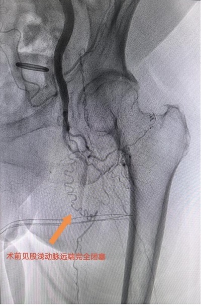 患者左腿動脈血管閉塞嚴(yán)重。重醫(yī)附屬大學(xué)城醫(yī)院供圖