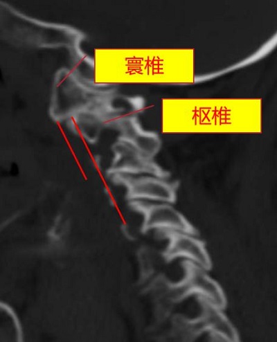 術(shù)前，頸椎CT顯示寰樞椎脫位（正常為寰椎、樞椎在同一水平線）。重慶市人民醫(yī)院（重慶大學(xué)附屬人民醫(yī)院）供圖