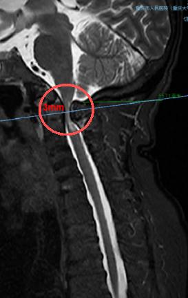 術(shù)前，頸椎MRI顯示，患者脊髓嚴(yán)重受壓（圓圈處）。重慶市人民醫(yī)院（重慶大學(xué)附屬人民醫(yī)院）供圖