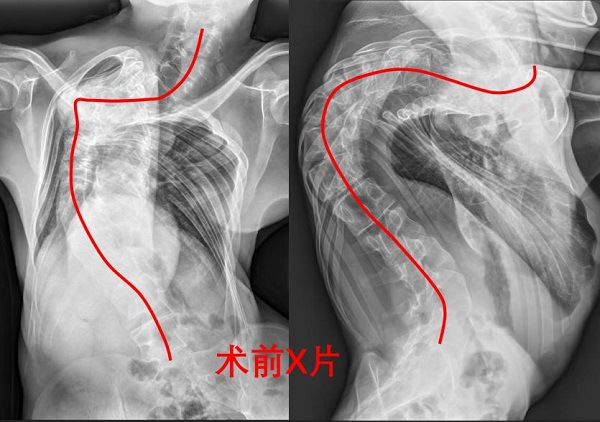 術(shù)前X片顯示，患者脊柱形態(tài)（紅線處）嚴重側(cè)彎。重醫(yī)附二院供圖